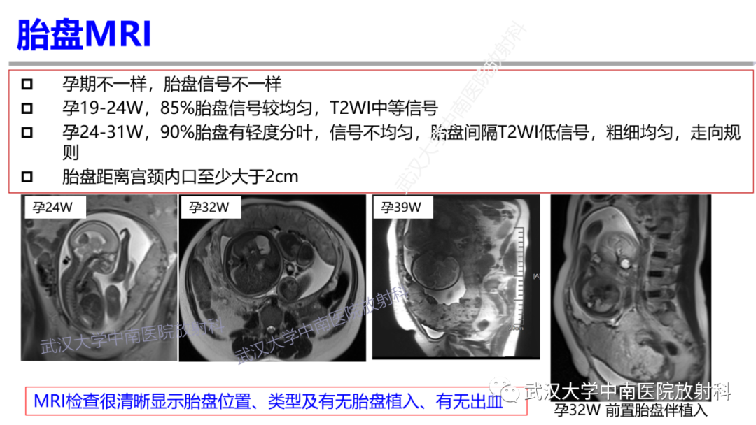 影像PPT - 【PPT】前置胎盘及胎盘植入磁共振成像-8