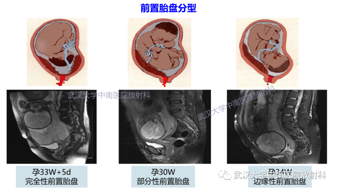 影像PPT - 【PPT】前置胎盘及胎盘植入磁共振成像-12