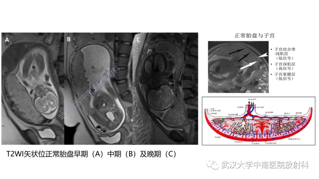 影像PPT - 【PPT】前置胎盘及胎盘植入磁共振成像-14