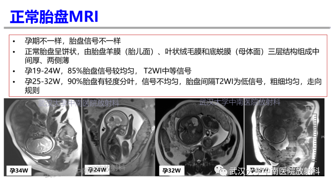 影像PPT - 【PPT】前置胎盘及胎盘植入磁共振成像-13