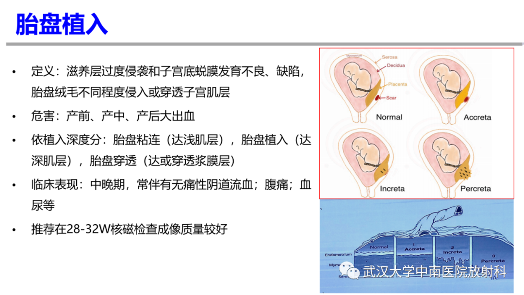 影像PPT - 【PPT】前置胎盘及胎盘植入磁共振成像-16