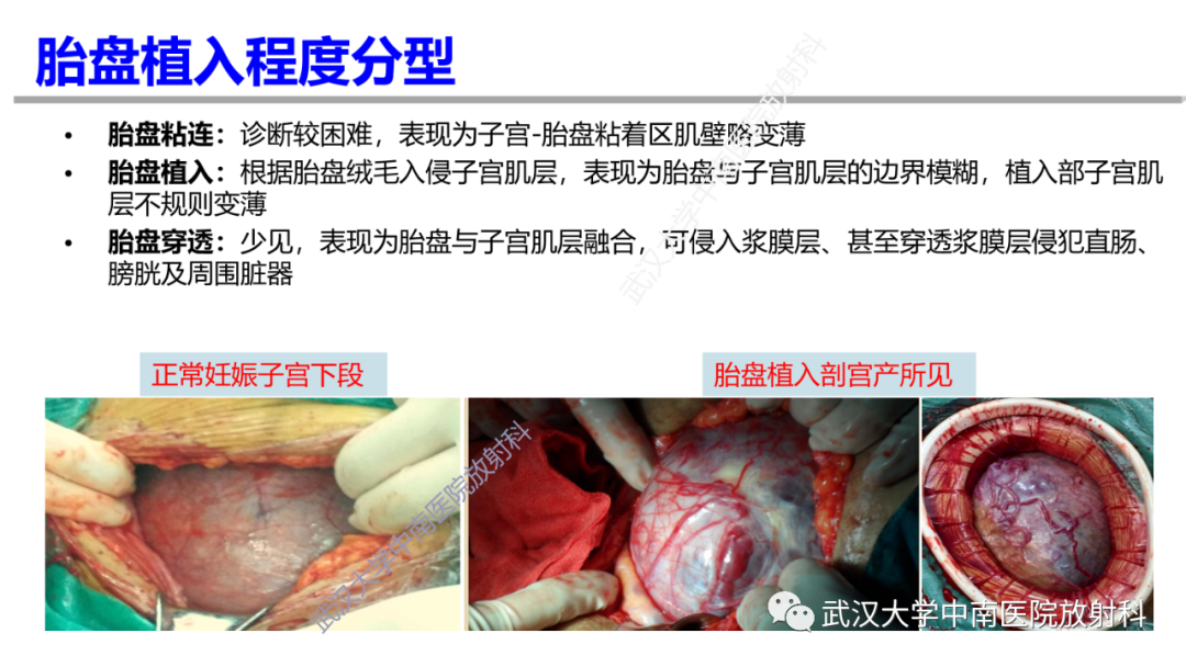 影像PPT - 【PPT】前置胎盘及胎盘植入磁共振成像-17