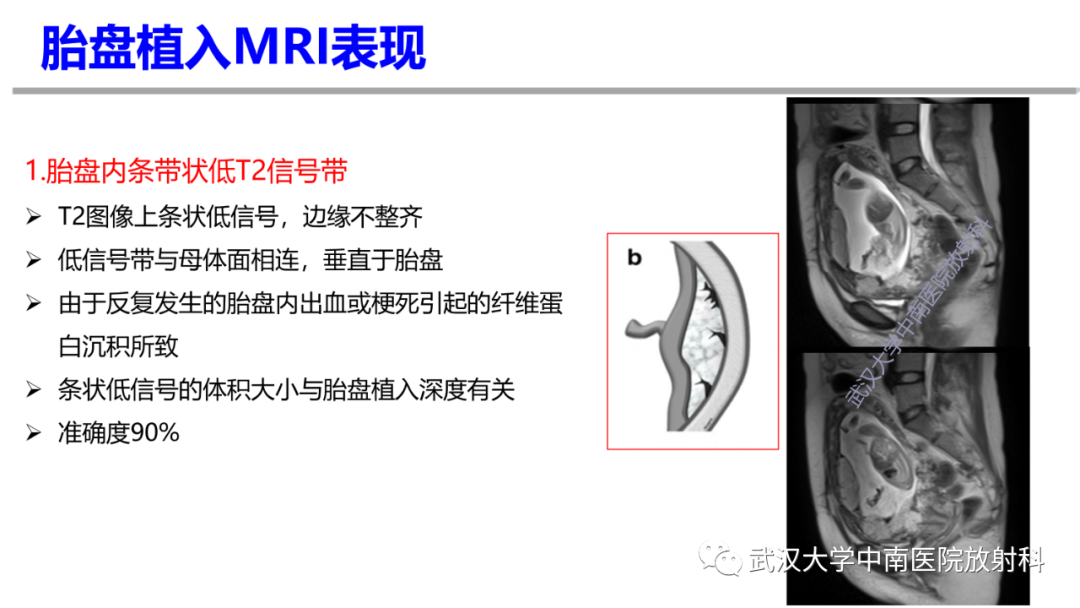 影像PPT - 【PPT】前置胎盘及胎盘植入磁共振成像-19