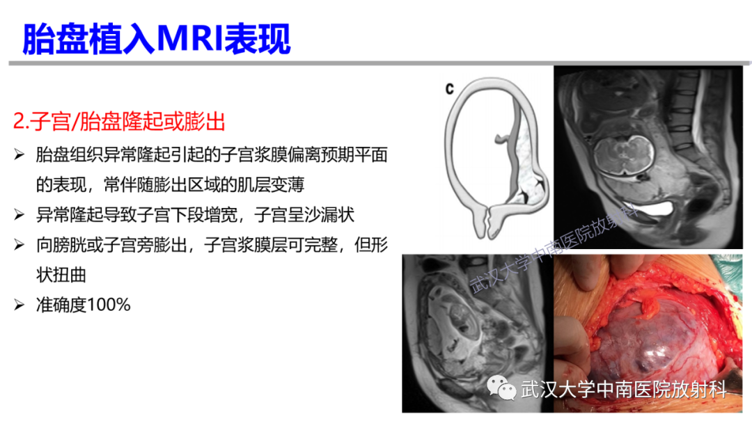 影像PPT - 【PPT】前置胎盘及胎盘植入磁共振成像-20