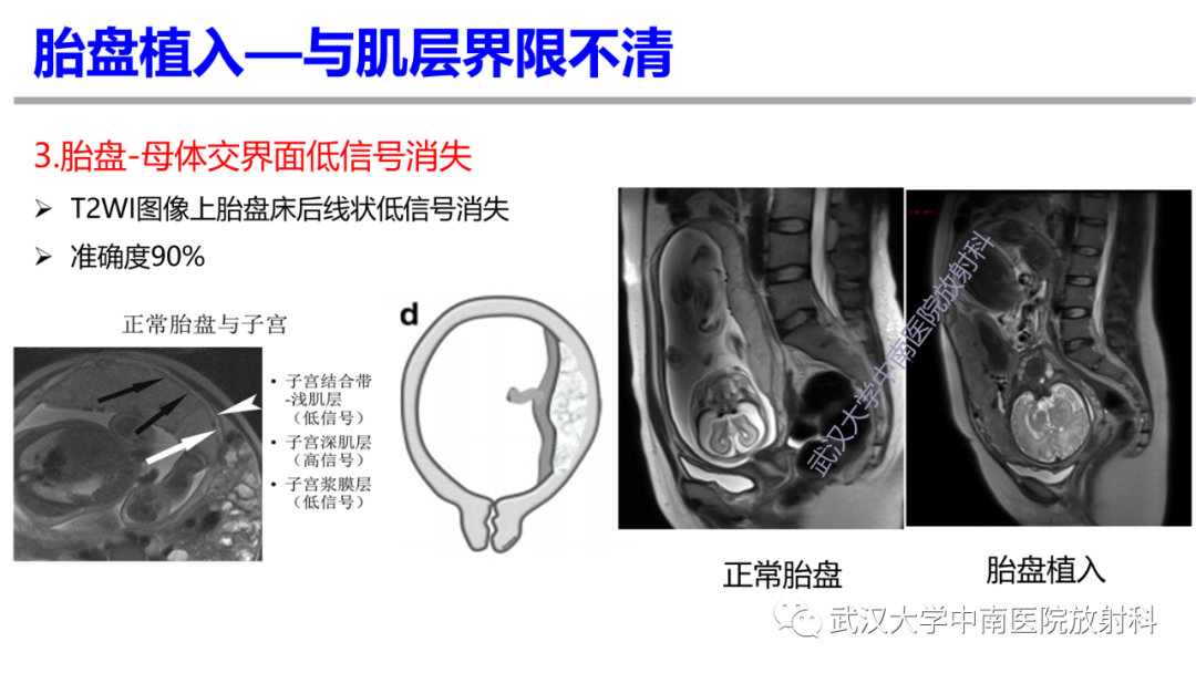 影像PPT - 【PPT】前置胎盘及胎盘植入磁共振成像-22