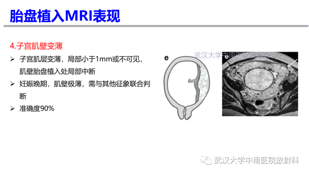 影像PPT - 【PPT】前置胎盘及胎盘植入磁共振成像-23