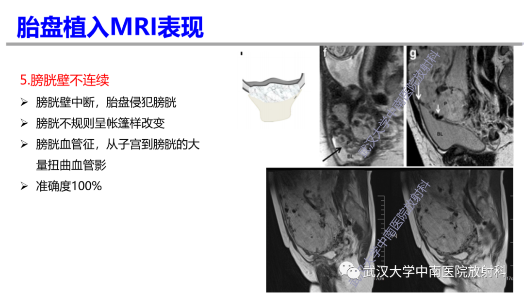 影像PPT - 【PPT】前置胎盘及胎盘植入磁共振成像-24