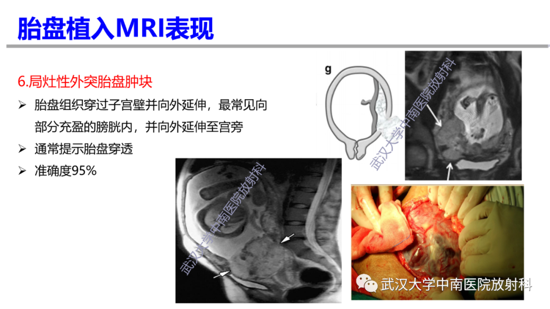 影像PPT - 【PPT】前置胎盘及胎盘植入磁共振成像-25