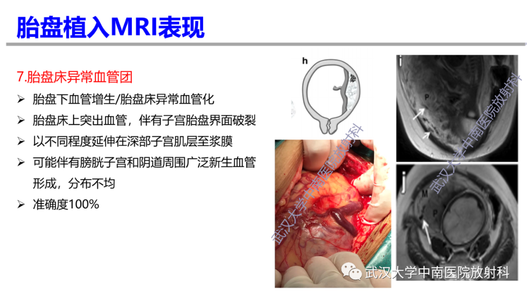 影像PPT - 【PPT】前置胎盘及胎盘植入磁共振成像-26