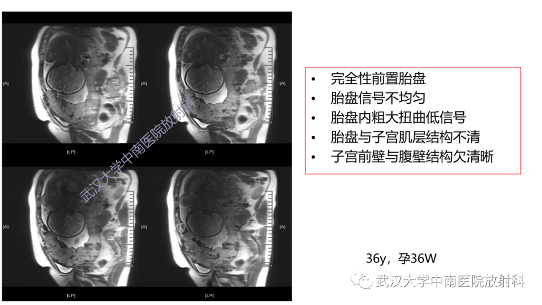 影像PPT - 【PPT】前置胎盘及胎盘植入磁共振成像-27