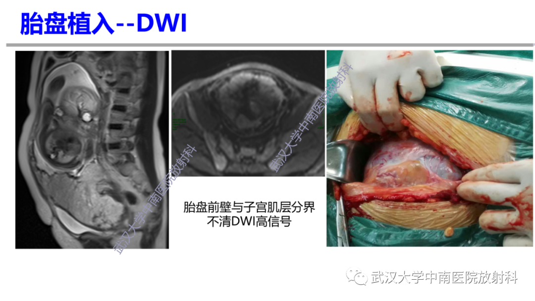 影像PPT - 【PPT】前置胎盘及胎盘植入磁共振成像-29