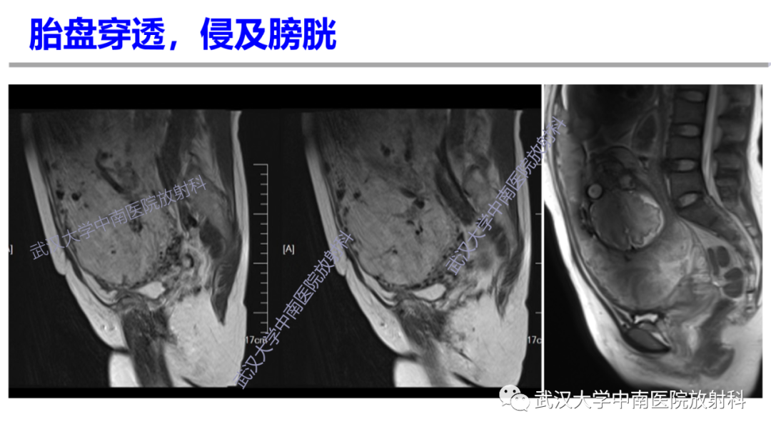 影像PPT - 【PPT】前置胎盘及胎盘植入磁共振成像-30