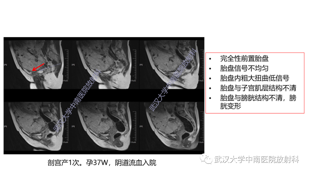 影像PPT - 【PPT】前置胎盘及胎盘植入磁共振成像-31