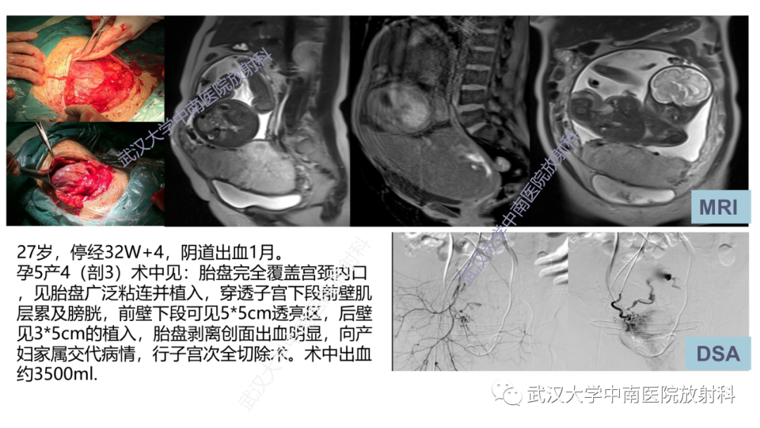 影像PPT - 【PPT】前置胎盘及胎盘植入磁共振成像-33