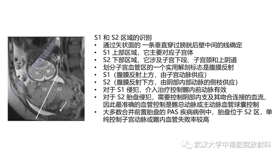 影像PPT - 【PPT】前置胎盘及胎盘植入磁共振成像-34