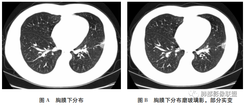 影像PPT - 【病例】新冠肺炎早期3例CT征象分析-2 影像PPT - 【病例】新冠肺炎早期3例CT征象分析-2