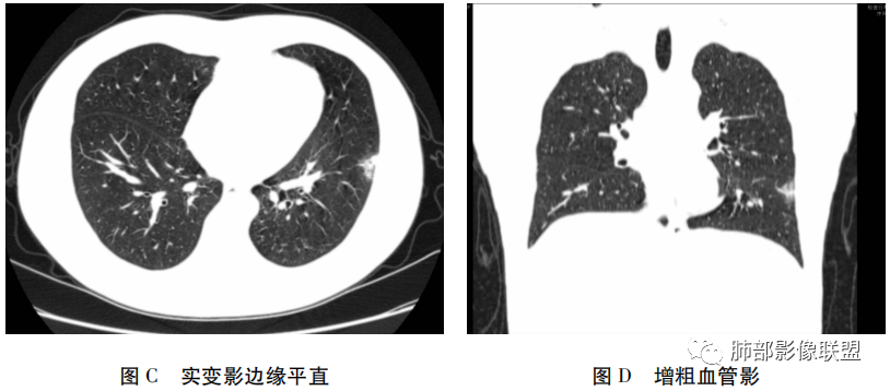 影像PPT - 【病例】新冠肺炎早期3例CT征象分析-3 影像PPT - 【病例】新冠肺炎早期3例CT征象分析-3