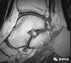影像PPT - 【病例】后踝关节撞击综合征1例MR影像-1