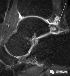 影像PPT - 【病例】后踝关节撞击综合征1例MR影像-3