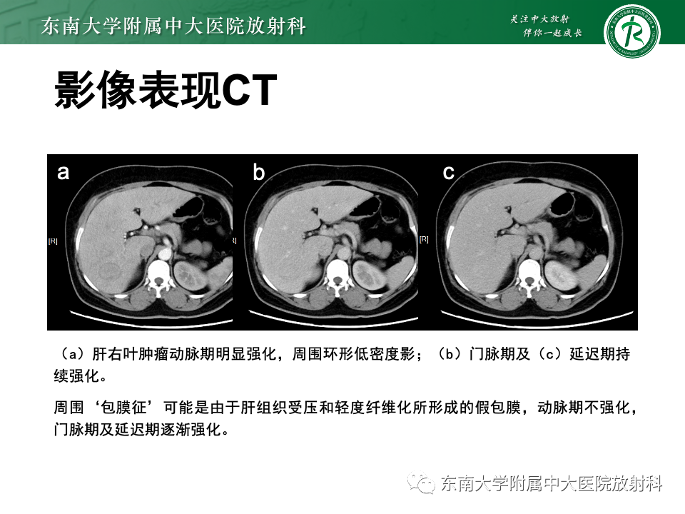 影像PPT - 【PPT】肝细胞腺瘤-4