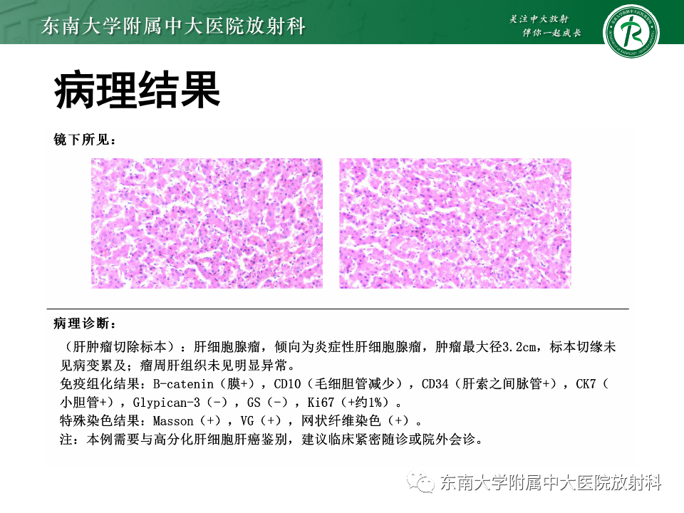 影像PPT - 【PPT】肝细胞腺瘤-6