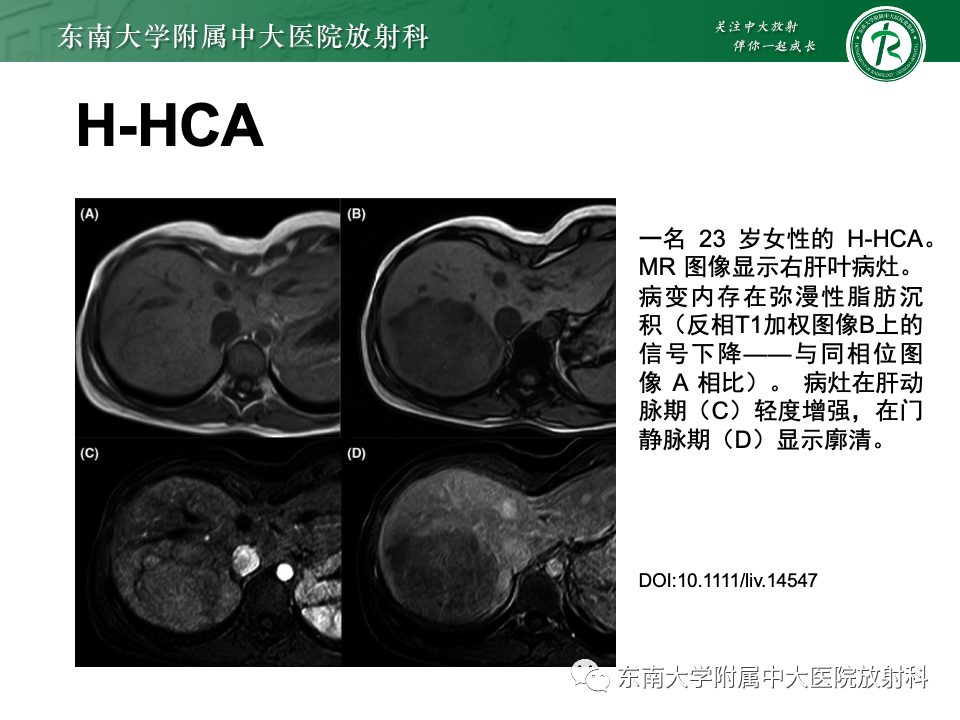 影像PPT - 【PPT】肝细胞腺瘤-16