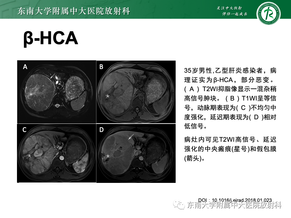 影像PPT - 【PPT】肝细胞腺瘤-19