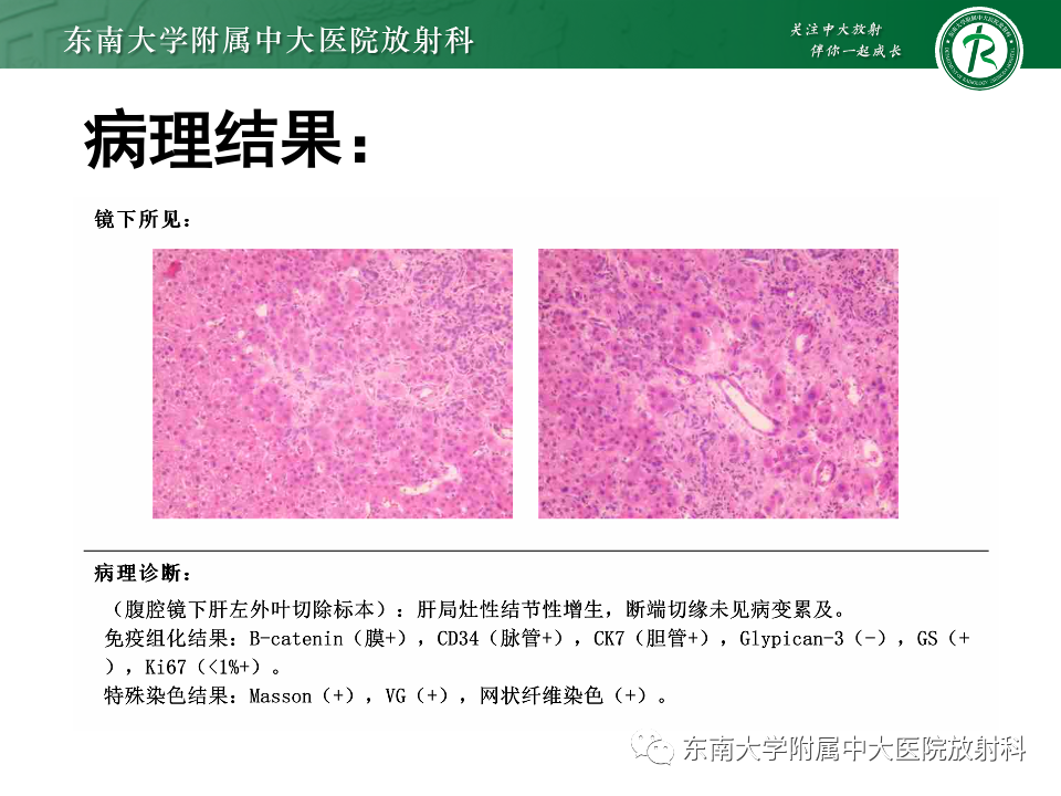 影像PPT - 【PPT】肝细胞腺瘤-22