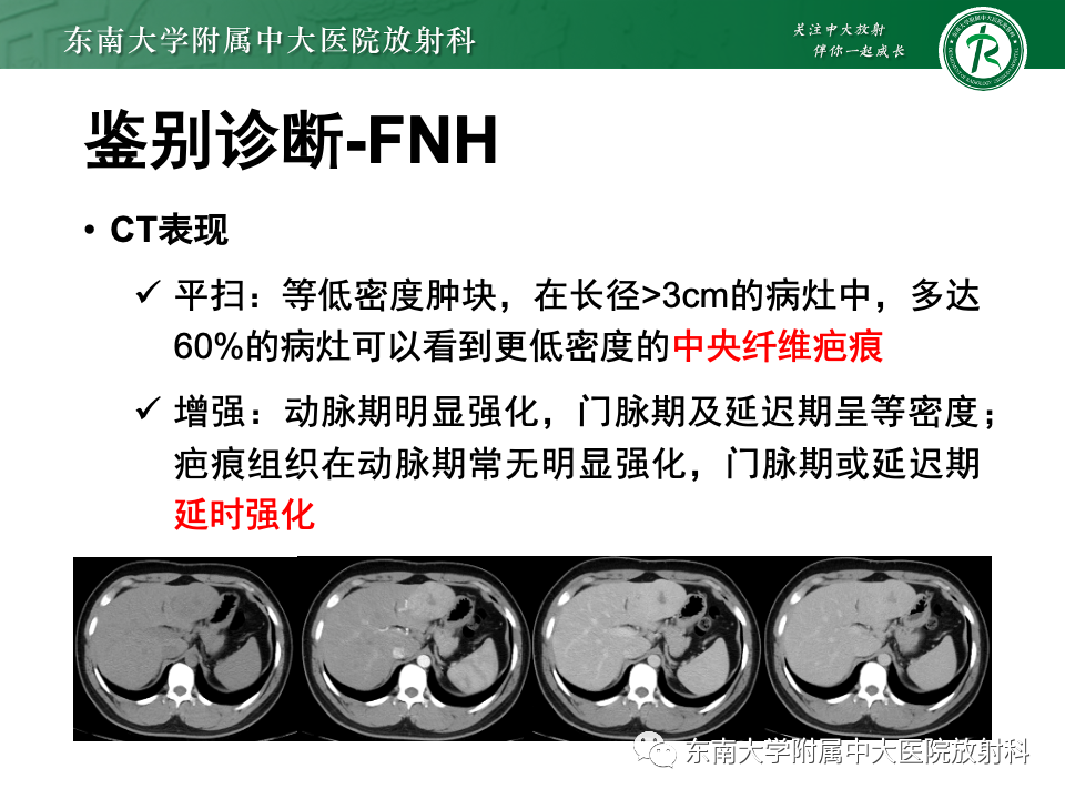 影像PPT - 【PPT】肝细胞腺瘤-25