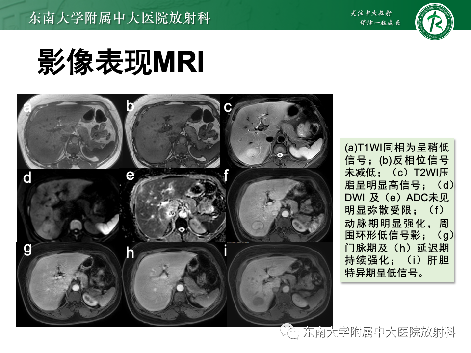 影像PPT - 【PPT】肝细胞腺瘤-1