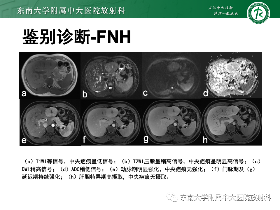 影像PPT - 【PPT】肝细胞腺瘤-5