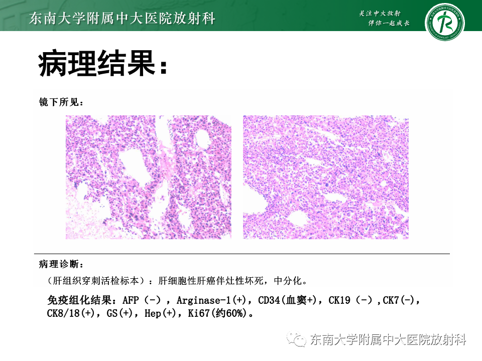 影像PPT - 【PPT】肝细胞腺瘤-6