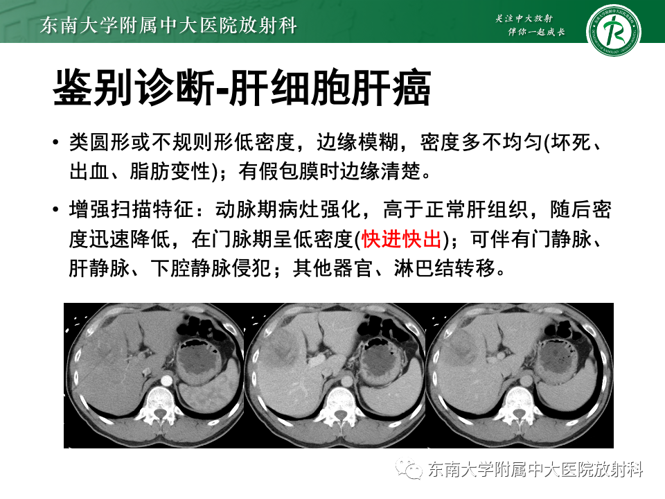 影像PPT - 【PPT】肝细胞腺瘤-8