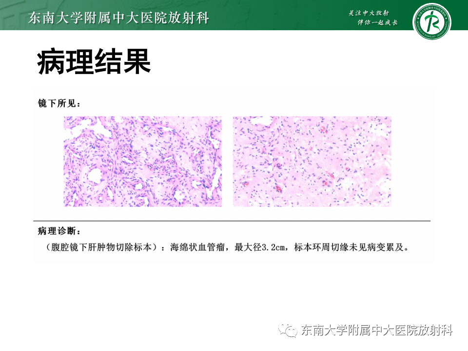 影像PPT - 【PPT】肝细胞腺瘤-12