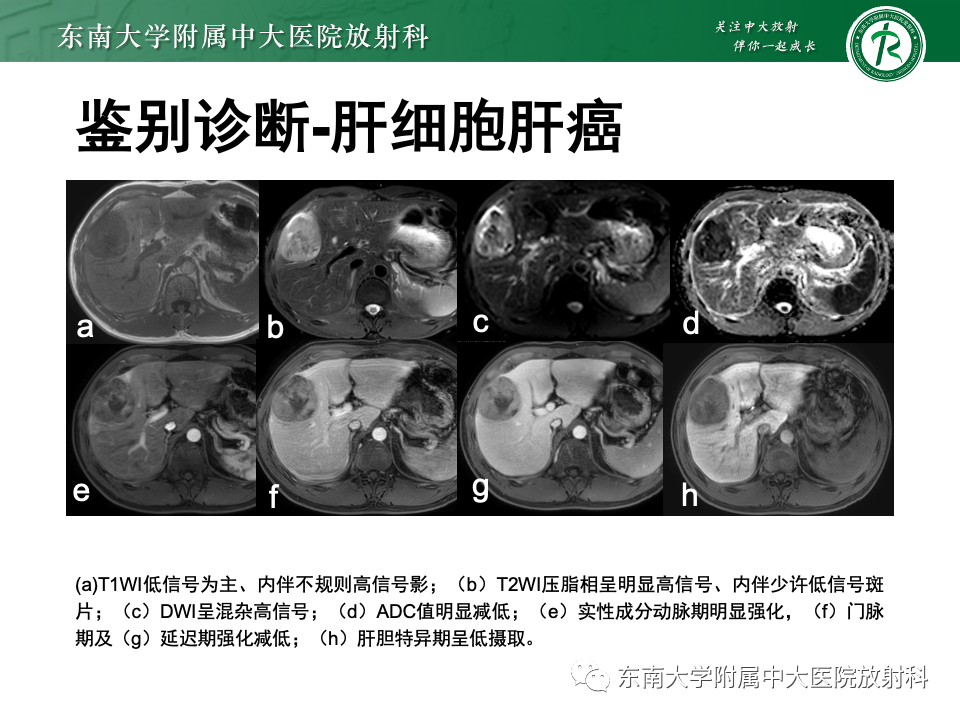 影像PPT - 【PPT】肝细胞腺瘤-10