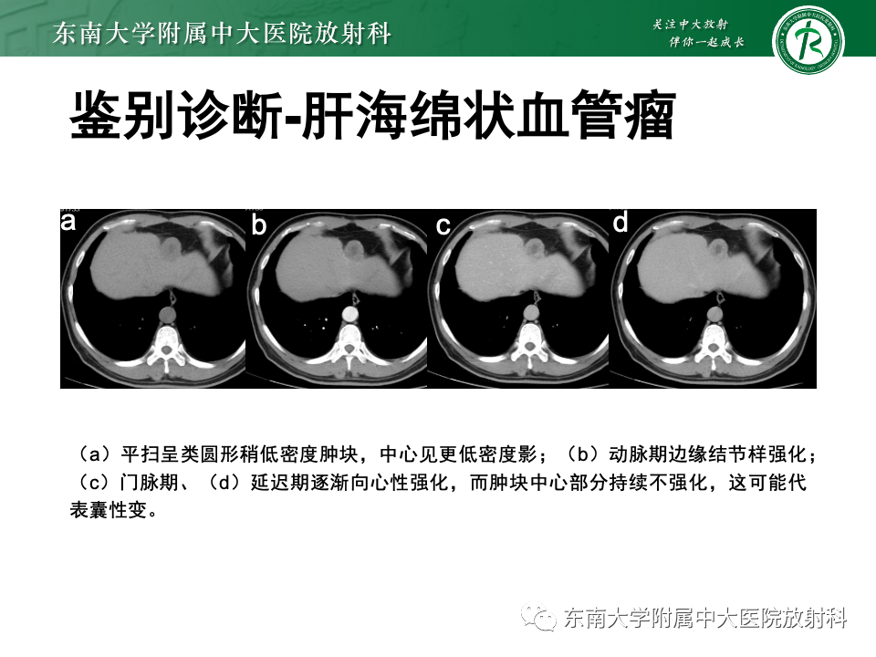 影像PPT - 【PPT】肝细胞腺瘤-14