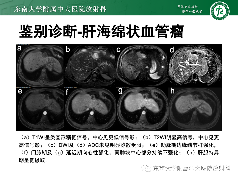 影像PPT - 【PPT】肝细胞腺瘤-15