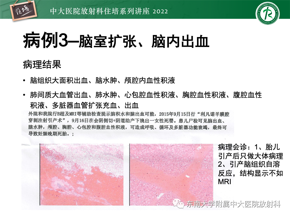 影像PPT - 【PPT】胎儿颅脑MRI技术及常见神经系统发育异常-7