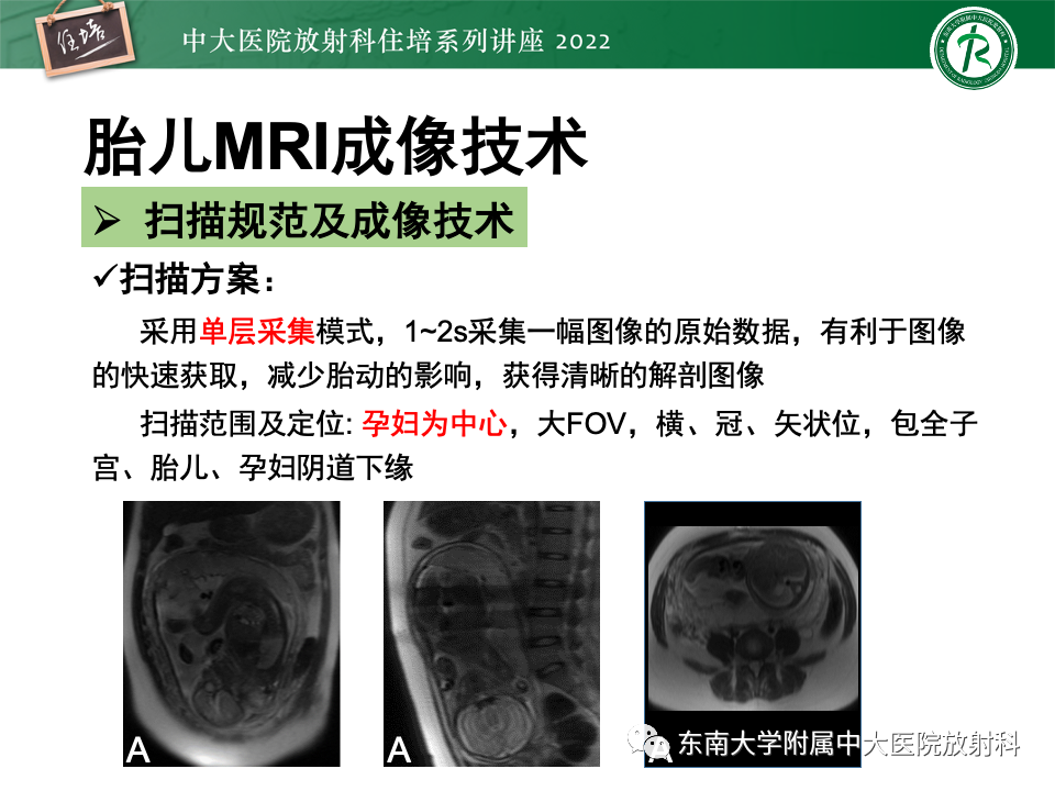 影像PPT - 【PPT】胎儿颅脑MRI技术及常见神经系统发育异常-17