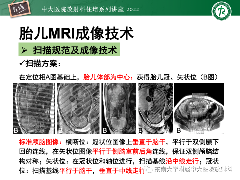 影像PPT - 【PPT】胎儿颅脑MRI技术及常见神经系统发育异常-18