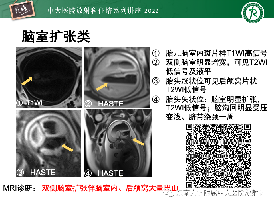 影像PPT - 【PPT】胎儿颅脑MRI技术及常见神经系统发育异常-5
