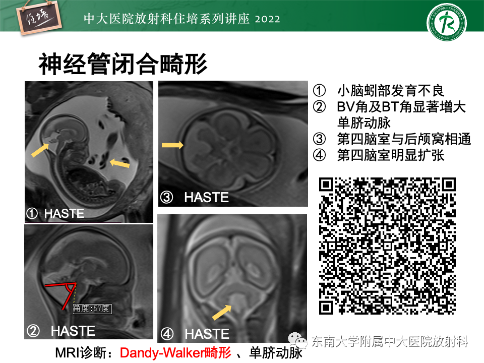 影像PPT - 【PPT】胎儿颅脑MRI技术及常见神经系统发育异常-3