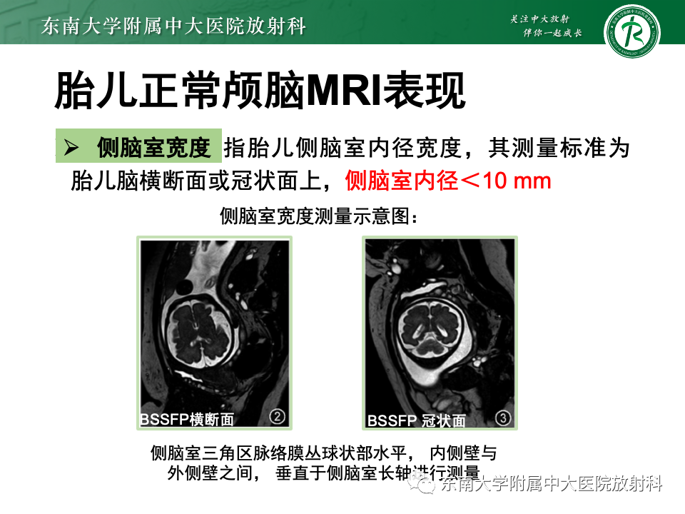 影像PPT - 【PPT】胎儿颅脑MRI技术及常见神经系统发育异常-12