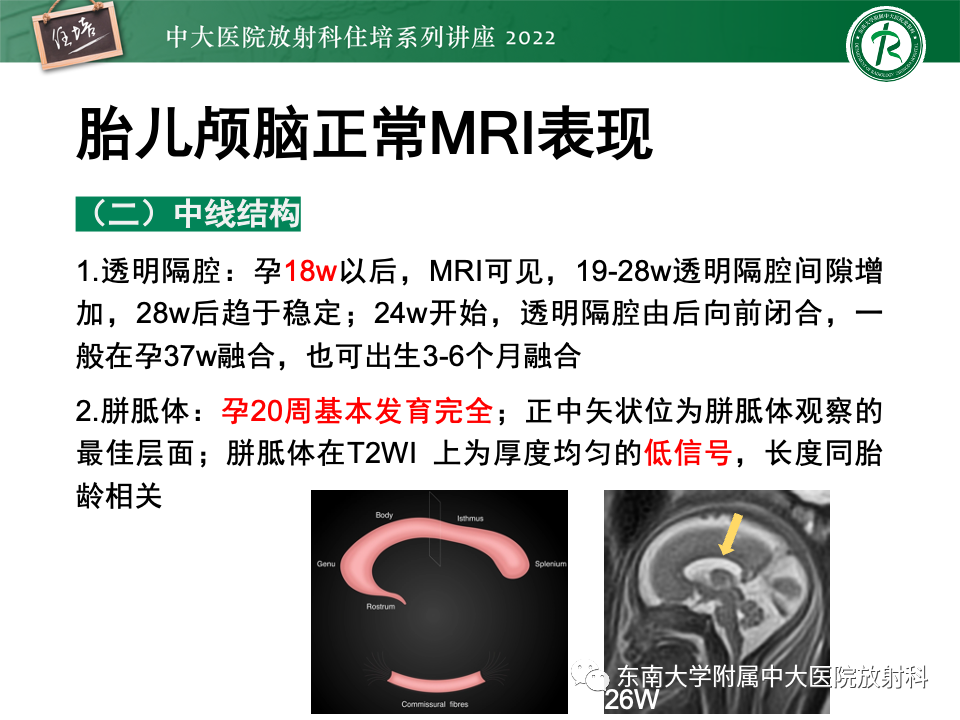 影像PPT - 【PPT】胎儿颅脑MRI技术及常见神经系统发育异常-13