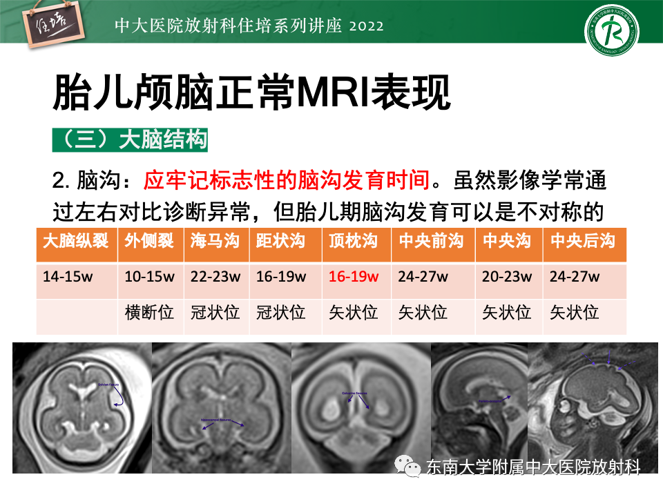 影像PPT - 【PPT】胎儿颅脑MRI技术及常见神经系统发育异常-16