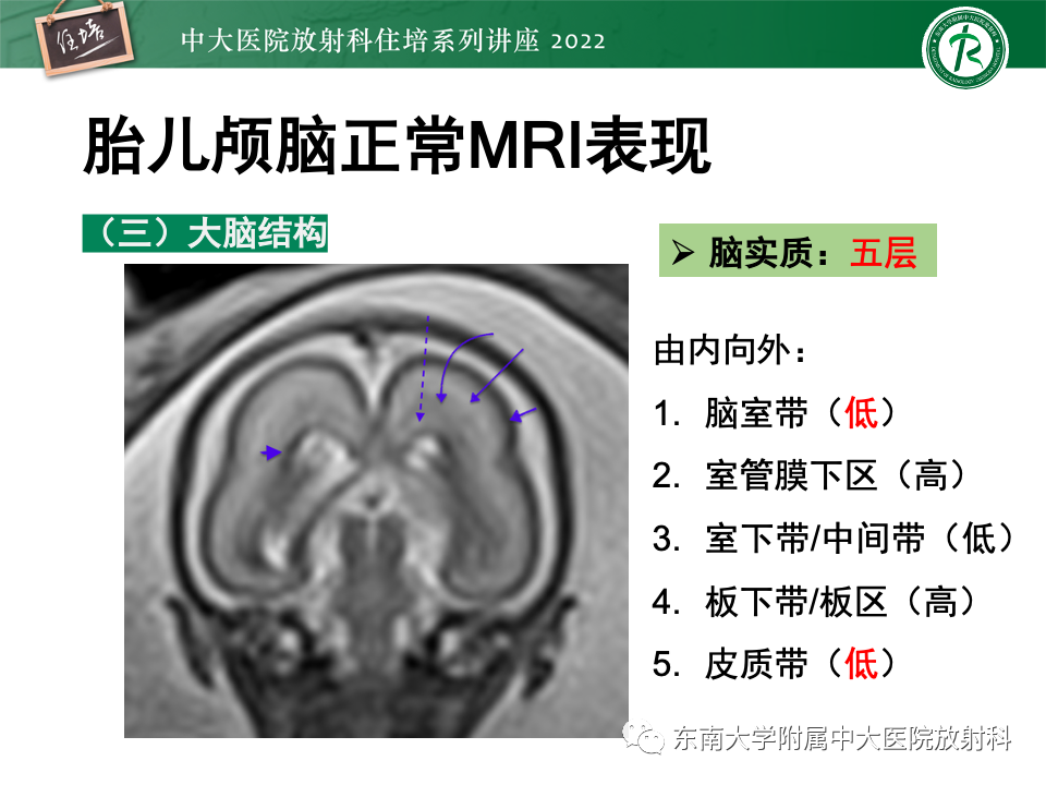 影像PPT - 【PPT】胎儿颅脑MRI技术及常见神经系统发育异常-15