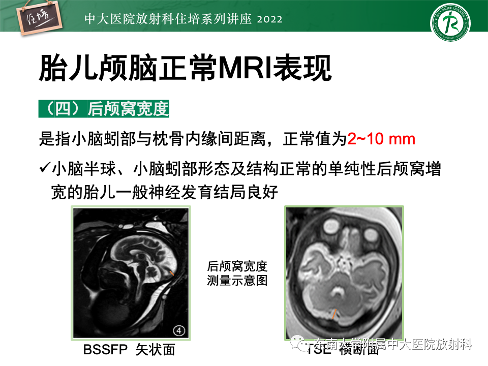 影像PPT - 【PPT】胎儿颅脑MRI技术及常见神经系统发育异常-18