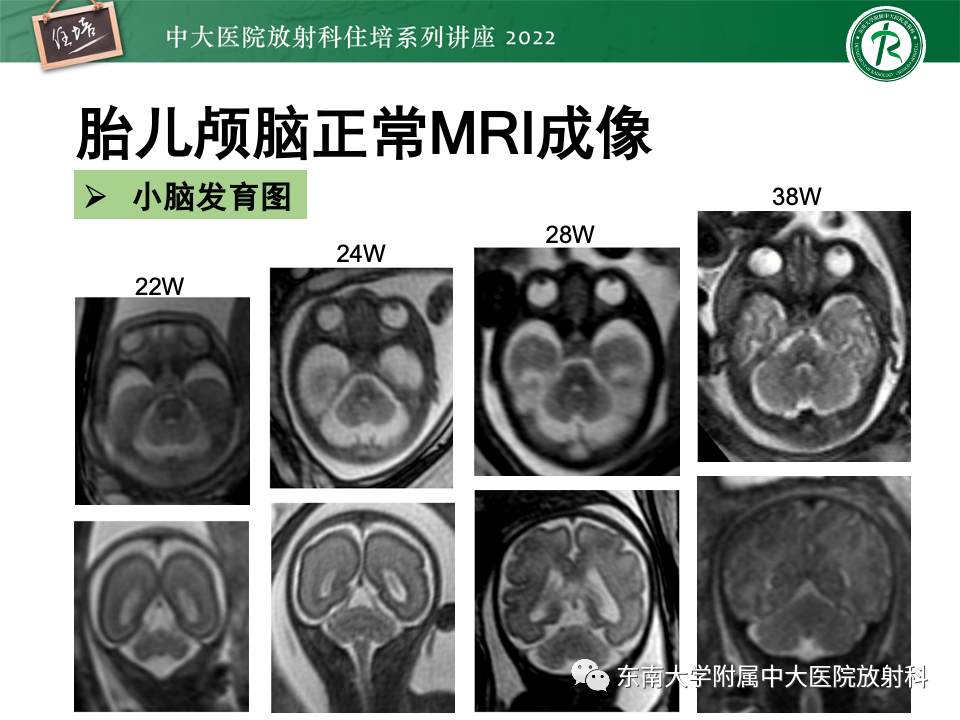 影像PPT - 【PPT】胎儿颅脑MRI技术及常见神经系统发育异常-20