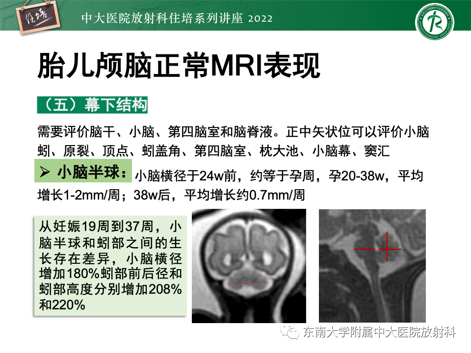 影像PPT - 【PPT】胎儿颅脑MRI技术及常见神经系统发育异常-19