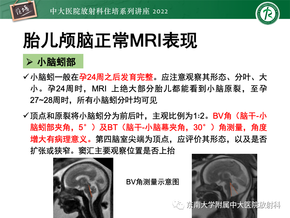 影像PPT - 【PPT】胎儿颅脑MRI技术及常见神经系统发育异常-21